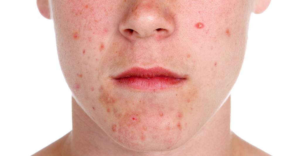 Comment traiter l’acné chez un adolescent naturellement ?